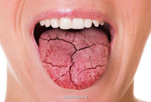 تاثیر میزان قند خون در ایجاد خشكی دهان