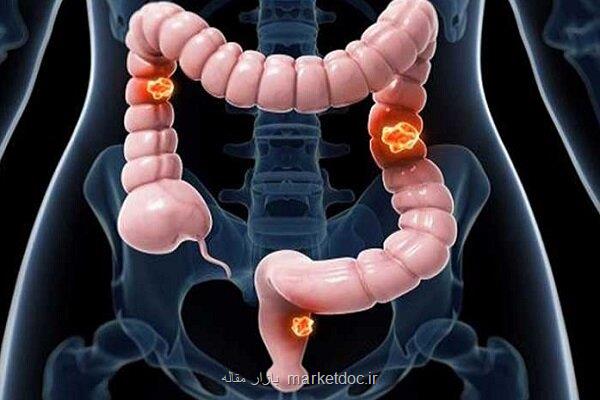 بررسی مهارکننده های دارویی در درمان سرطان روده بزرگ