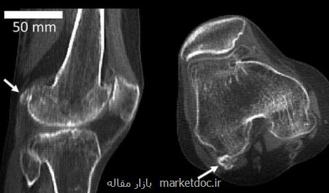 استخوان منسوخ شده باردیگر در بدن انسان ظاهر شد!